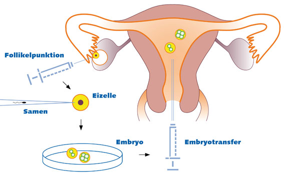 Intracytoplasmic Sperm Injection Icsi Nurture Fertility Centre Women S Specialty Clinic